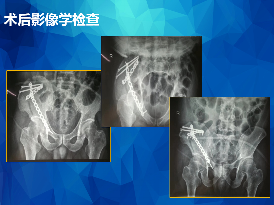 Stoppa及其改良入路治疗骨盆髋臼骨折