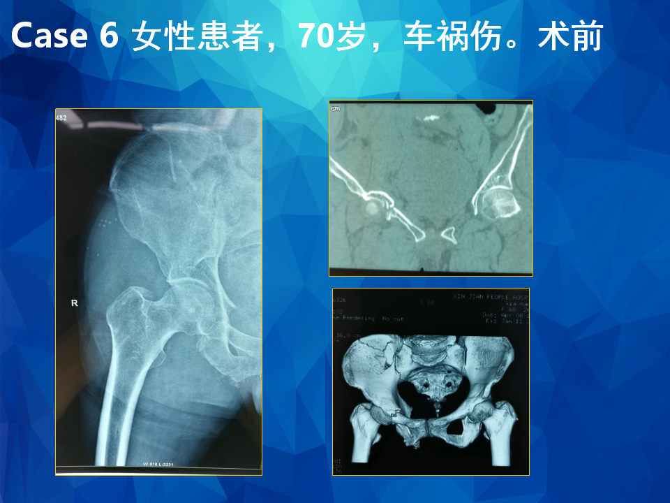 Stoppa及其改良入路治疗骨盆髋臼骨折