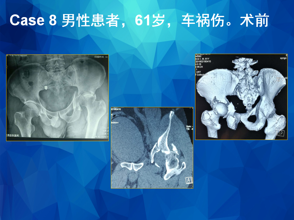 Stoppa及其改良入路治疗骨盆髋臼骨折