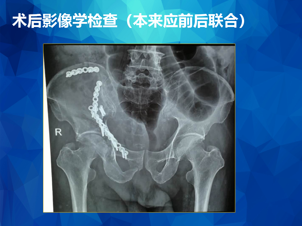 Stoppa及其改良入路治疗骨盆髋臼骨折