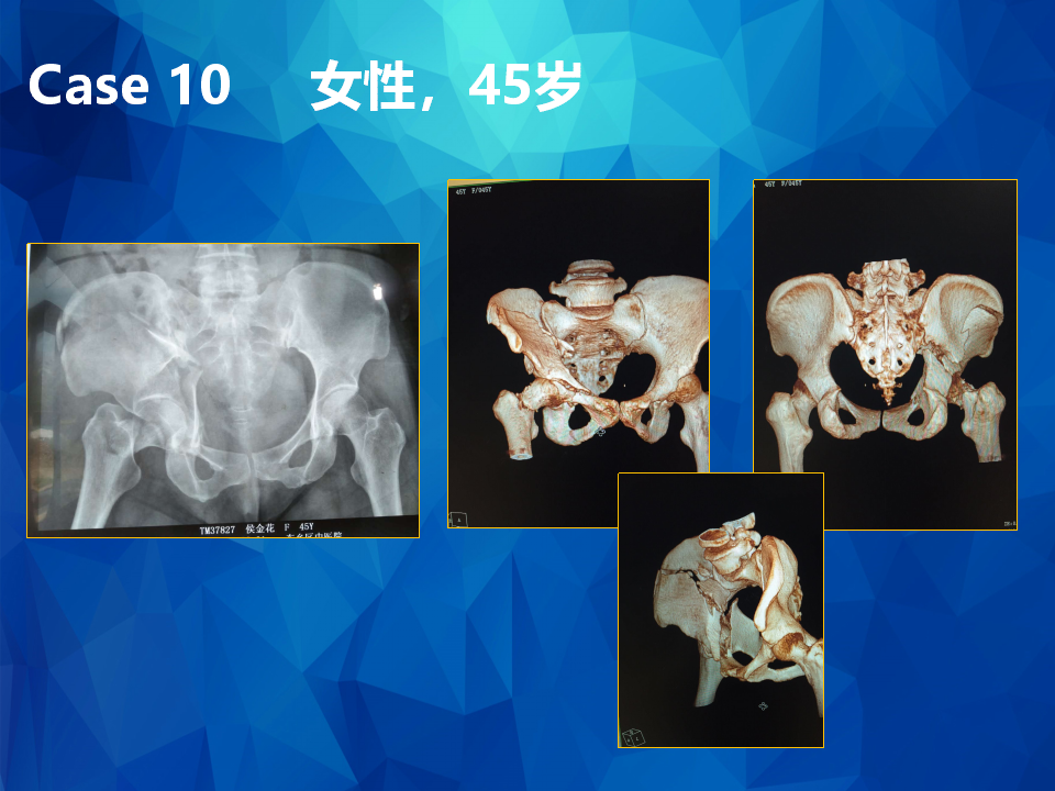 Stoppa及其改良入路治疗骨盆髋臼骨折