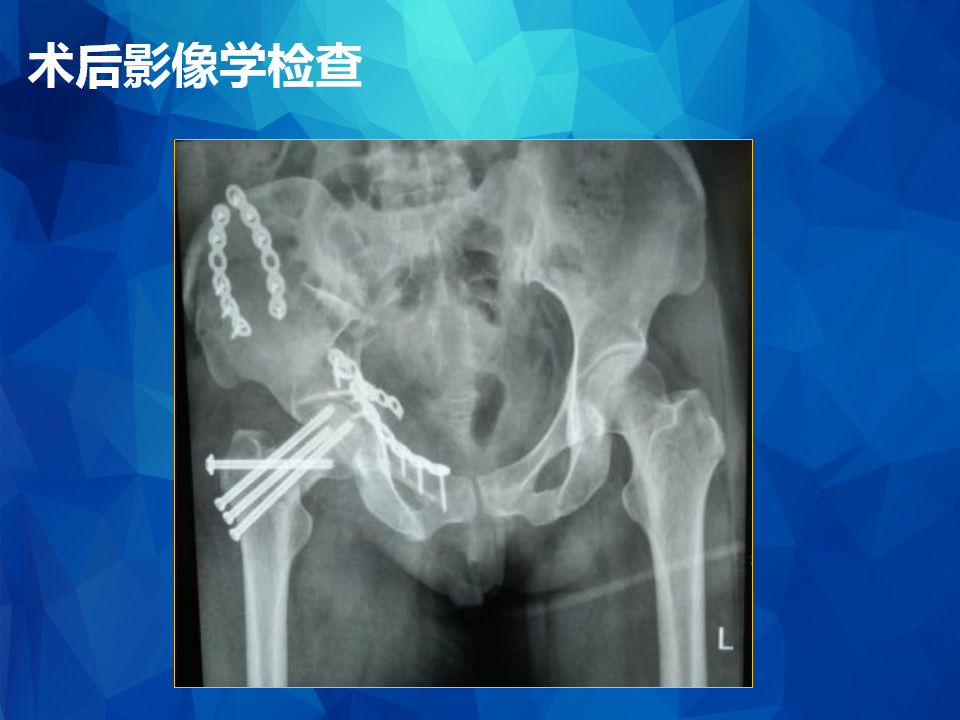 Stoppa及其改良入路治疗骨盆髋臼骨折