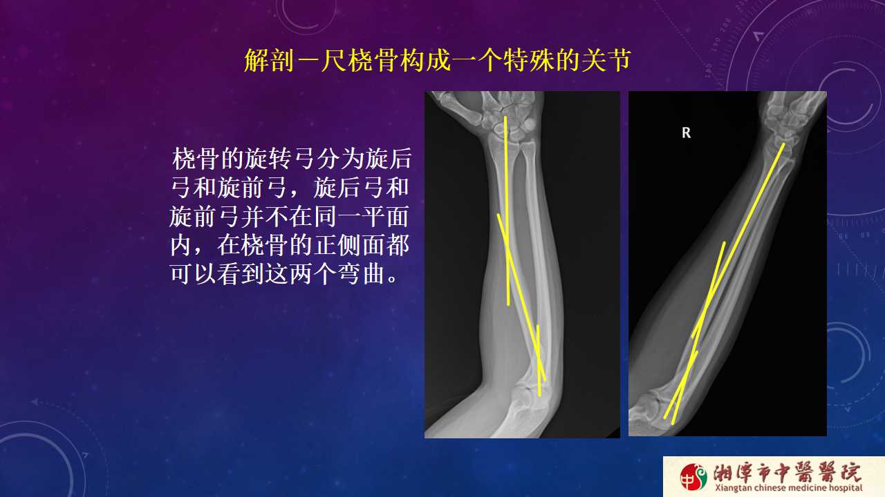 杨氏旋后牵引法治疗尺桡骨骨折