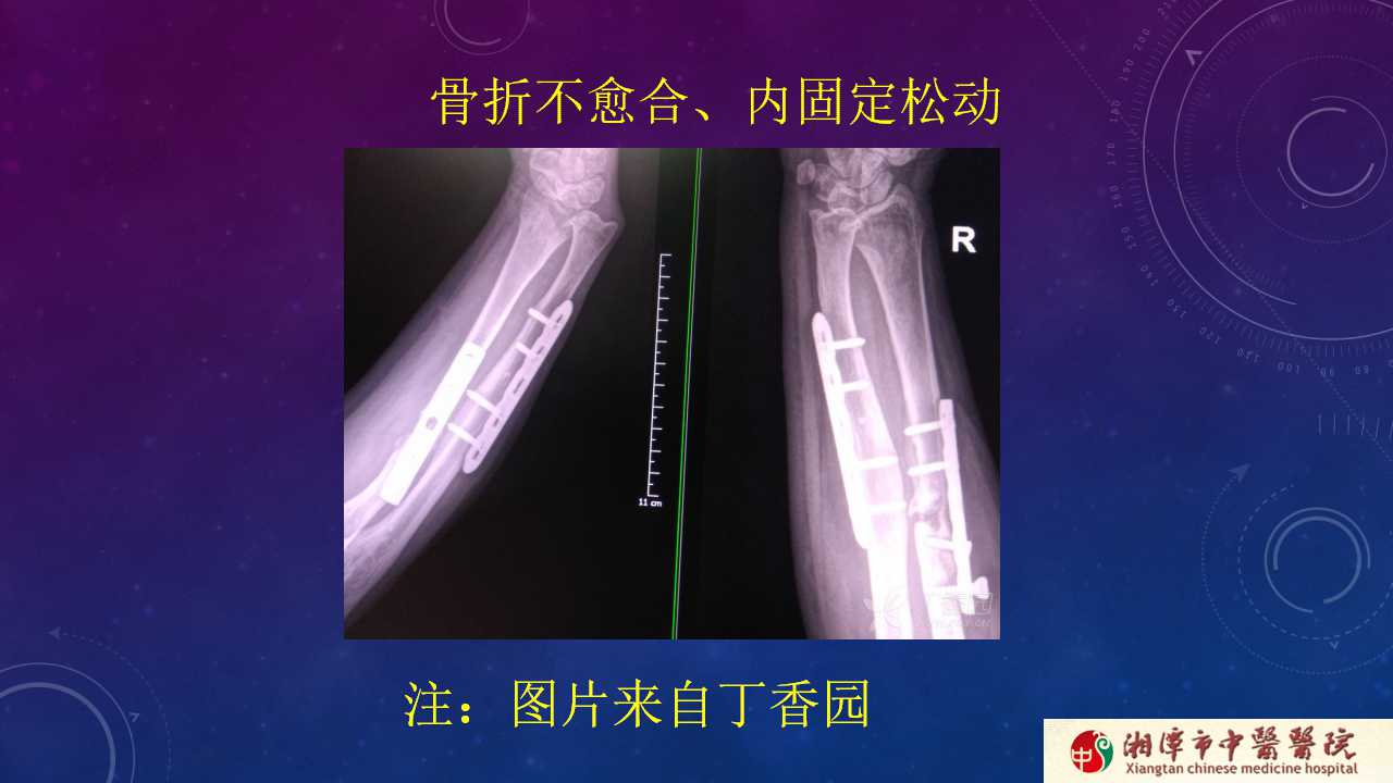 杨氏旋后牵引法治疗尺桡骨骨折