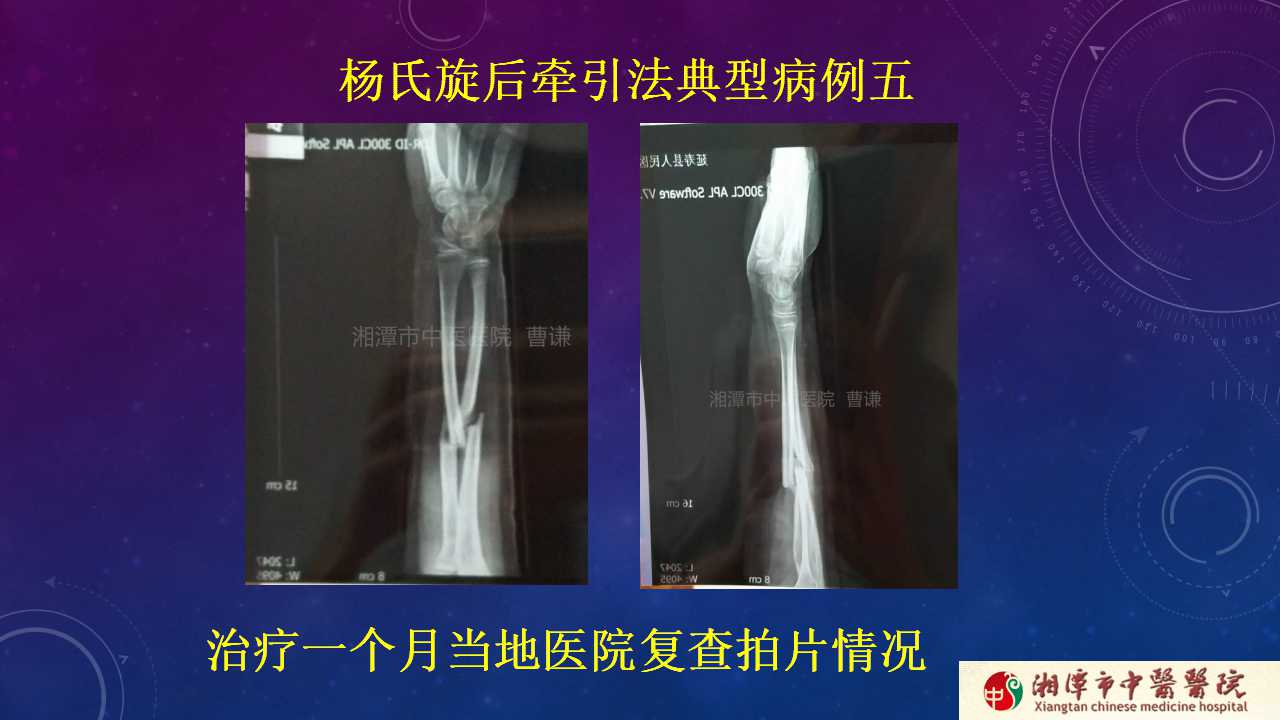 杨氏旋后牵引法治疗尺桡骨骨折