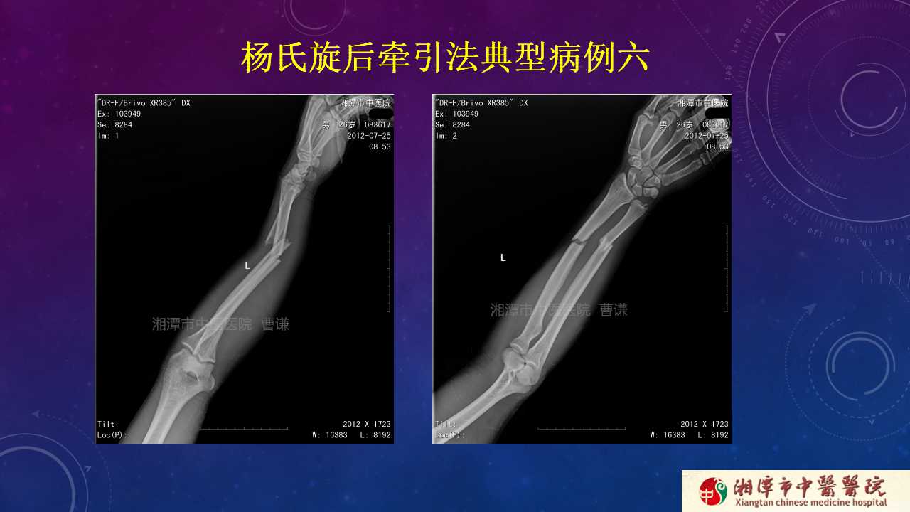 杨氏旋后牵引法治疗尺桡骨骨折