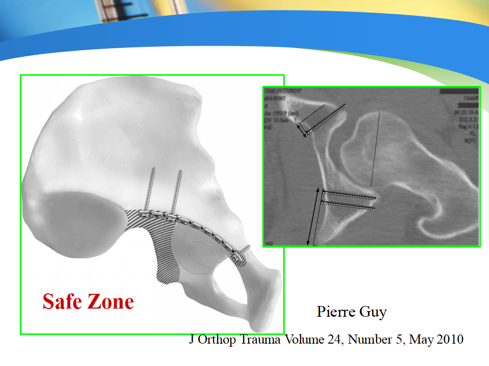 骨盆髋臼骨折如何选择手术入路？
