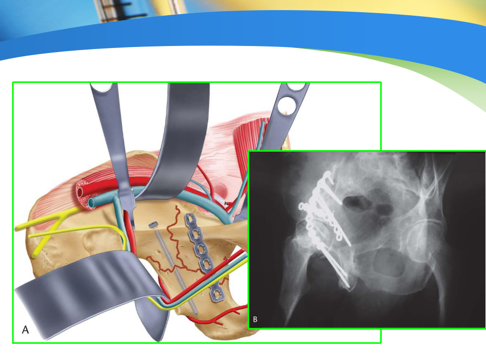 骨盆髋臼骨折如何选择手术入路？