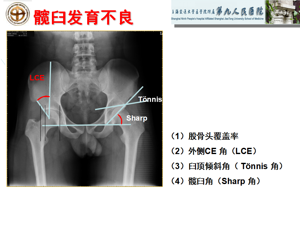 如何做好成人髋关节影像学诊断？