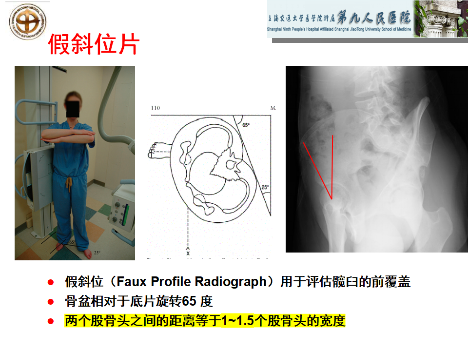 如何做好成人髋关节影像学诊断？