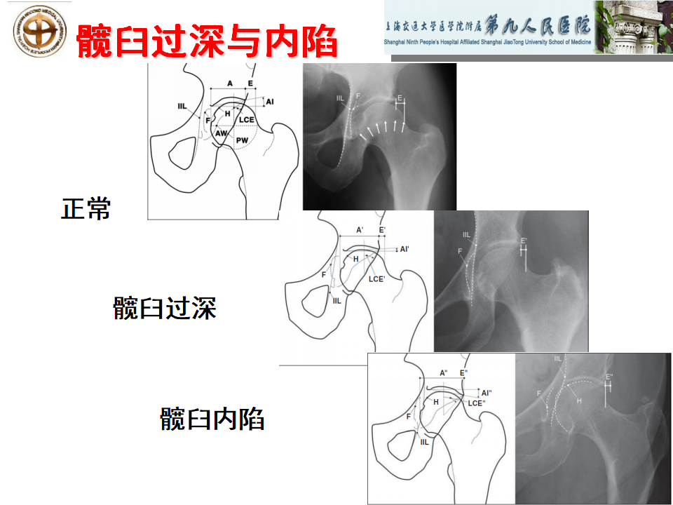 如何做好成人髋关节影像学诊断？