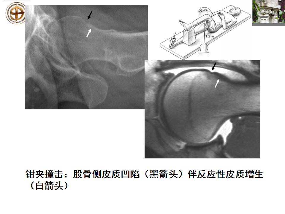 如何做好成人髋关节影像学诊断？