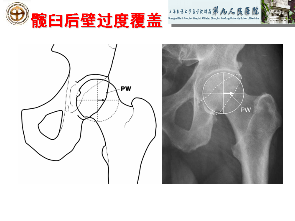 如何做好成人髋关节影像学诊断？