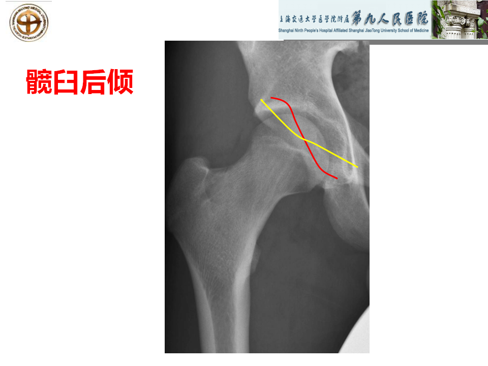 如何做好成人髋关节影像学诊断？