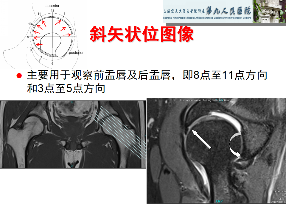 如何做好成人髋关节影像学诊断？