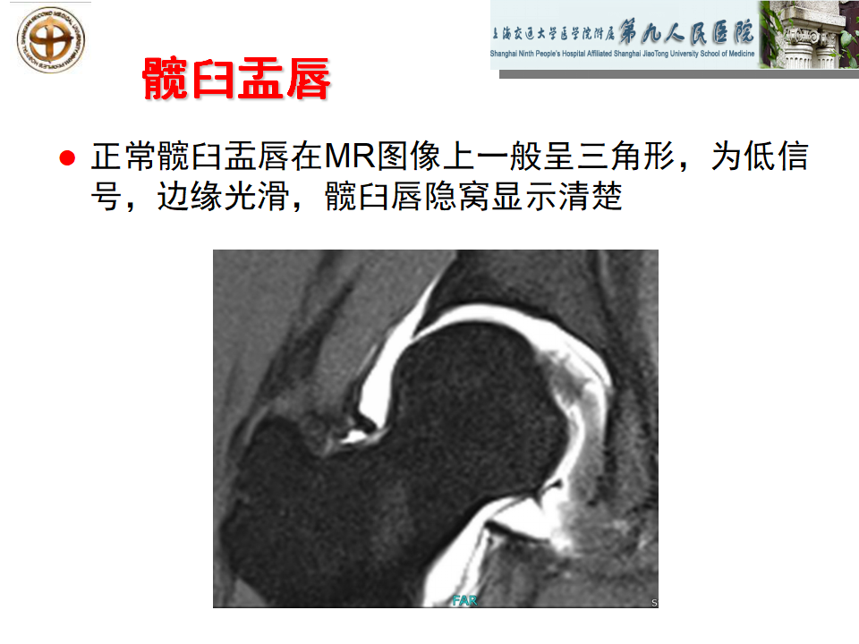 如何做好成人髋关节影像学诊断？