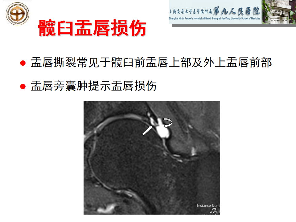 如何做好成人髋关节影像学诊断？