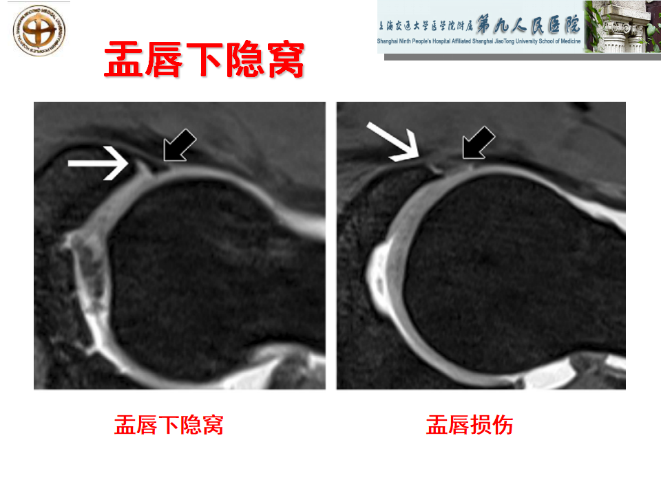 如何做好成人髋关节影像学诊断？