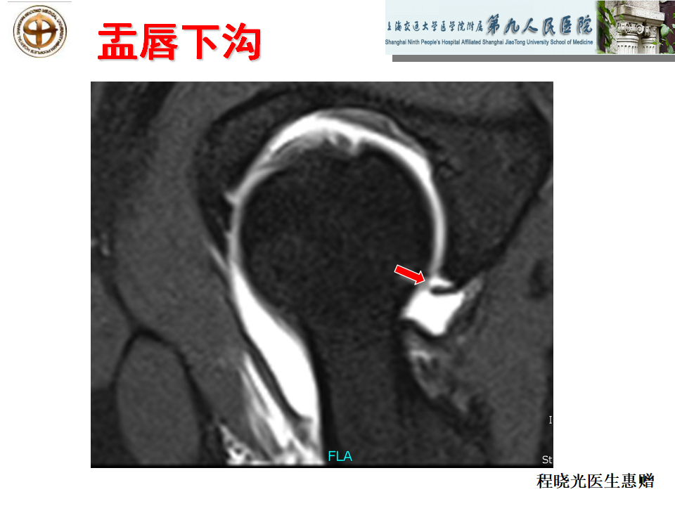 如何做好成人髋关节影像学诊断？