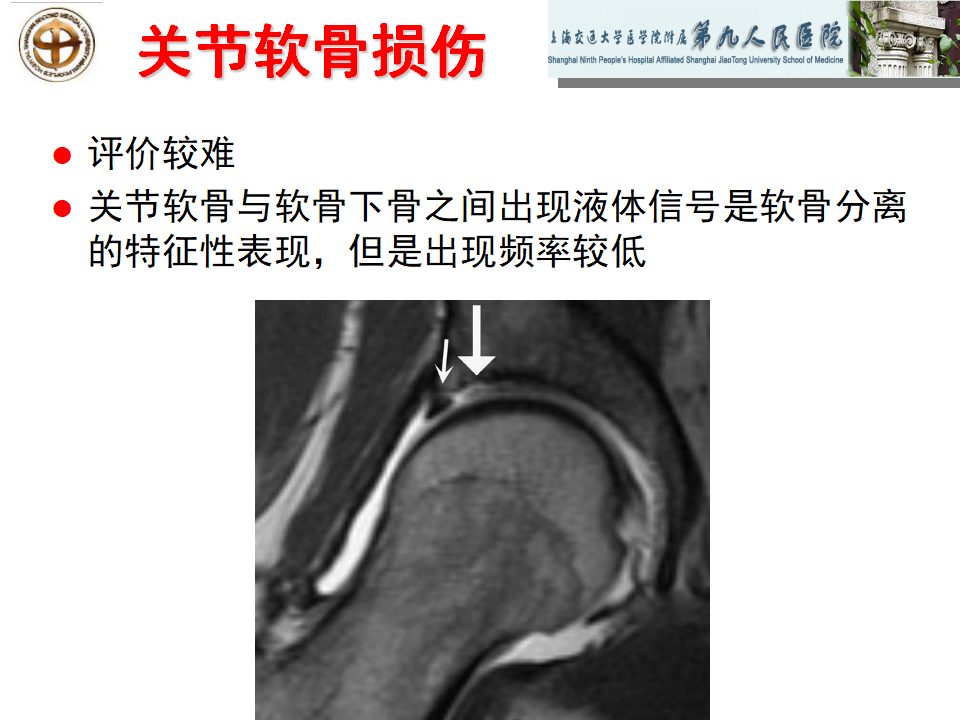 如何做好成人髋关节影像学诊断？