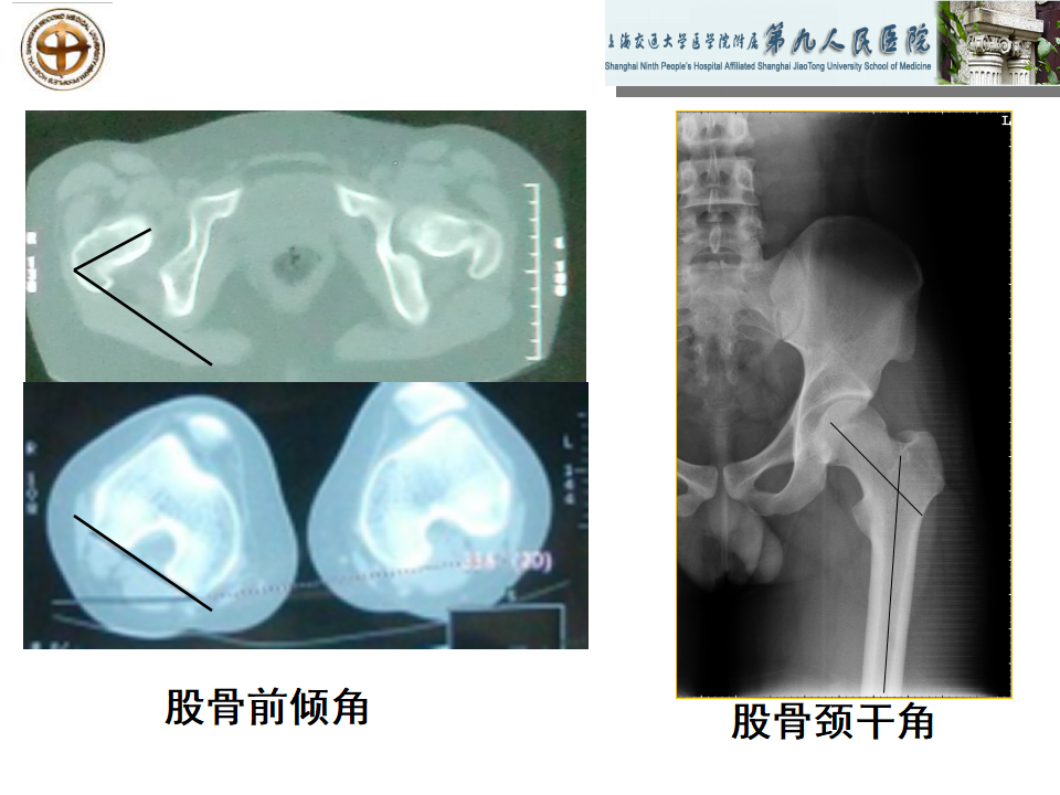 如何做好成人髋关节影像学诊断？