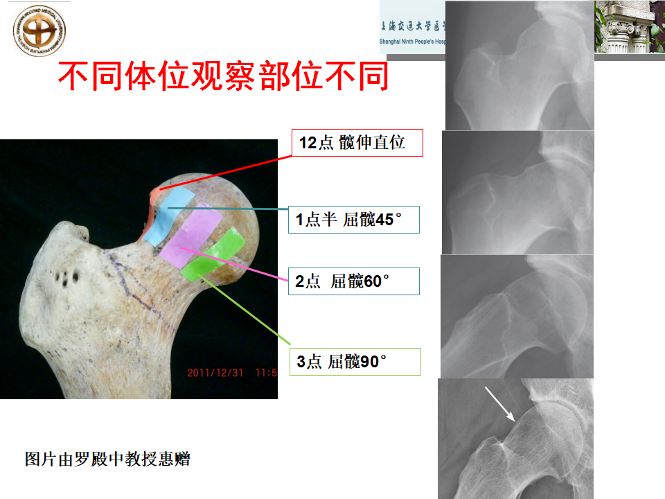 如何做好成人髋关节影像学诊断？