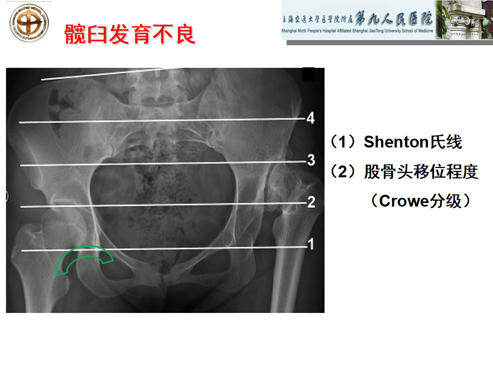 如何做好成人髋关节影像学诊断？