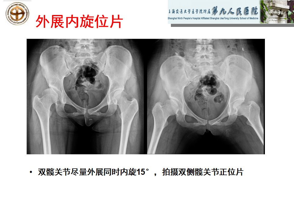 如何做好成人髋关节影像学诊断？