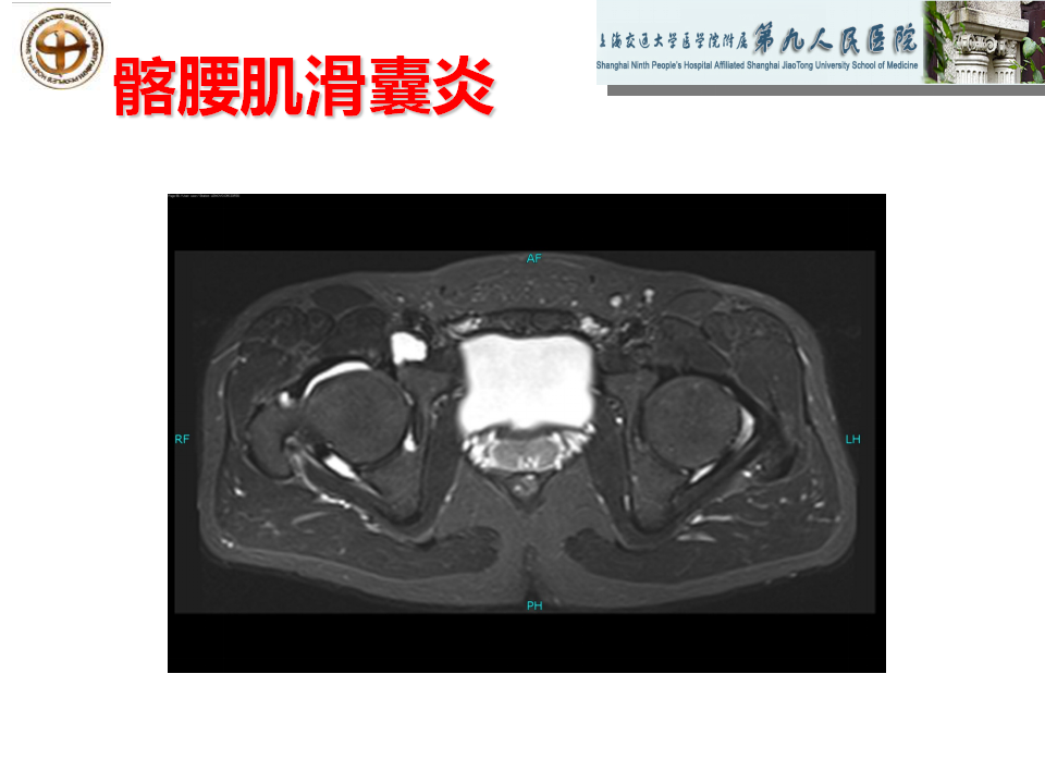 如何做好成人髋关节影像学诊断？