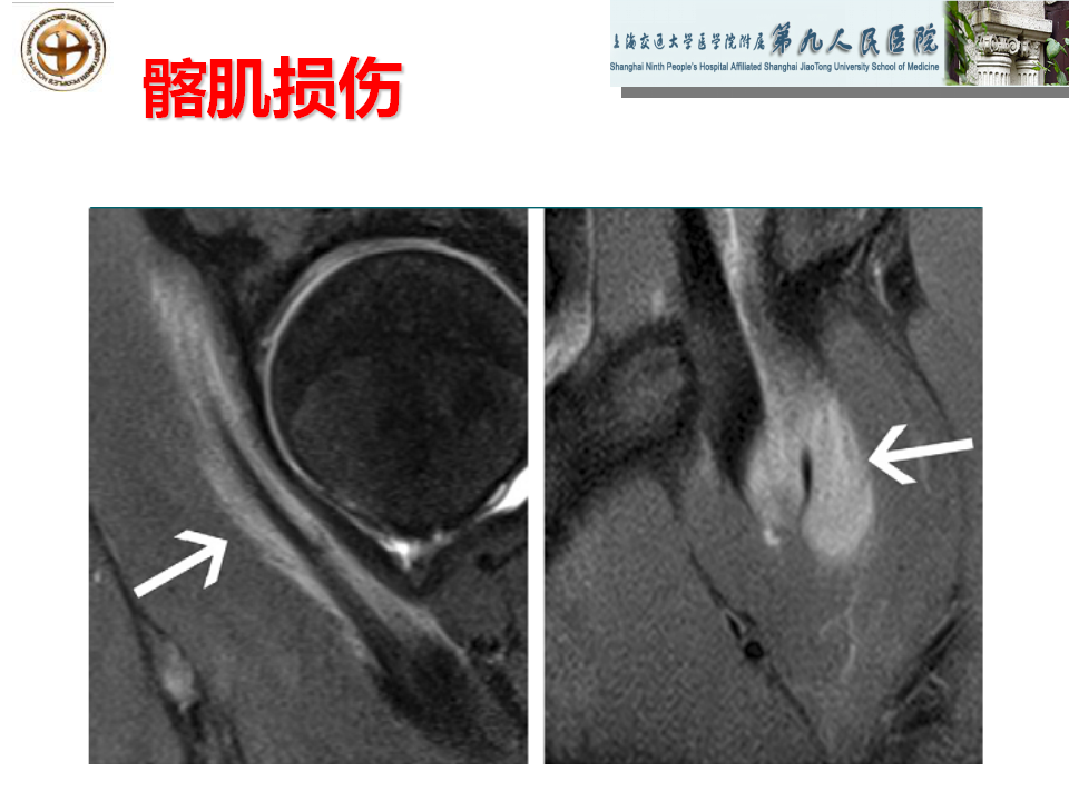 如何做好成人髋关节影像学诊断？