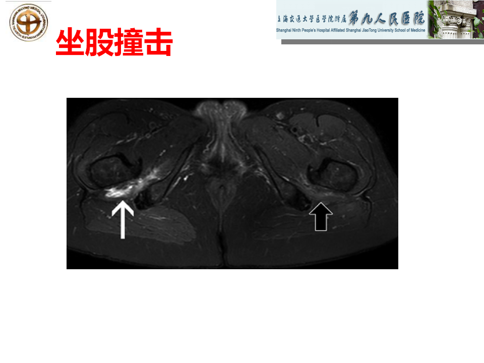 如何做好成人髋关节影像学诊断？