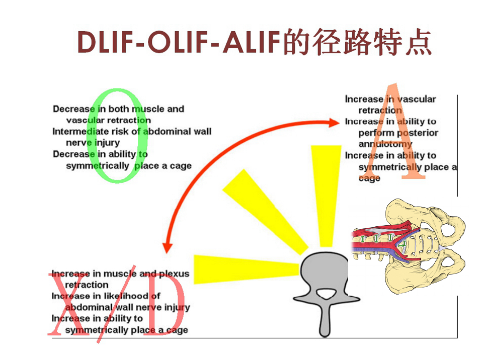 详解腰椎融合术OLIF入路！
