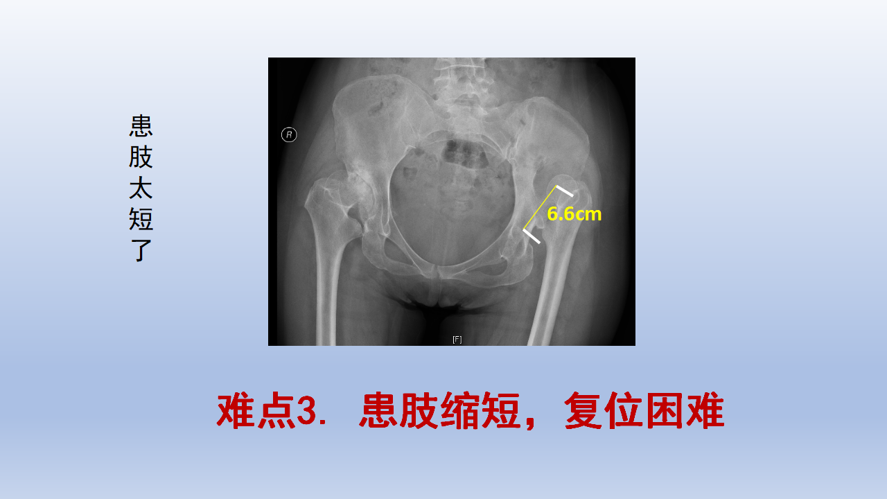 DDH全髋关节置换手术难点及对策