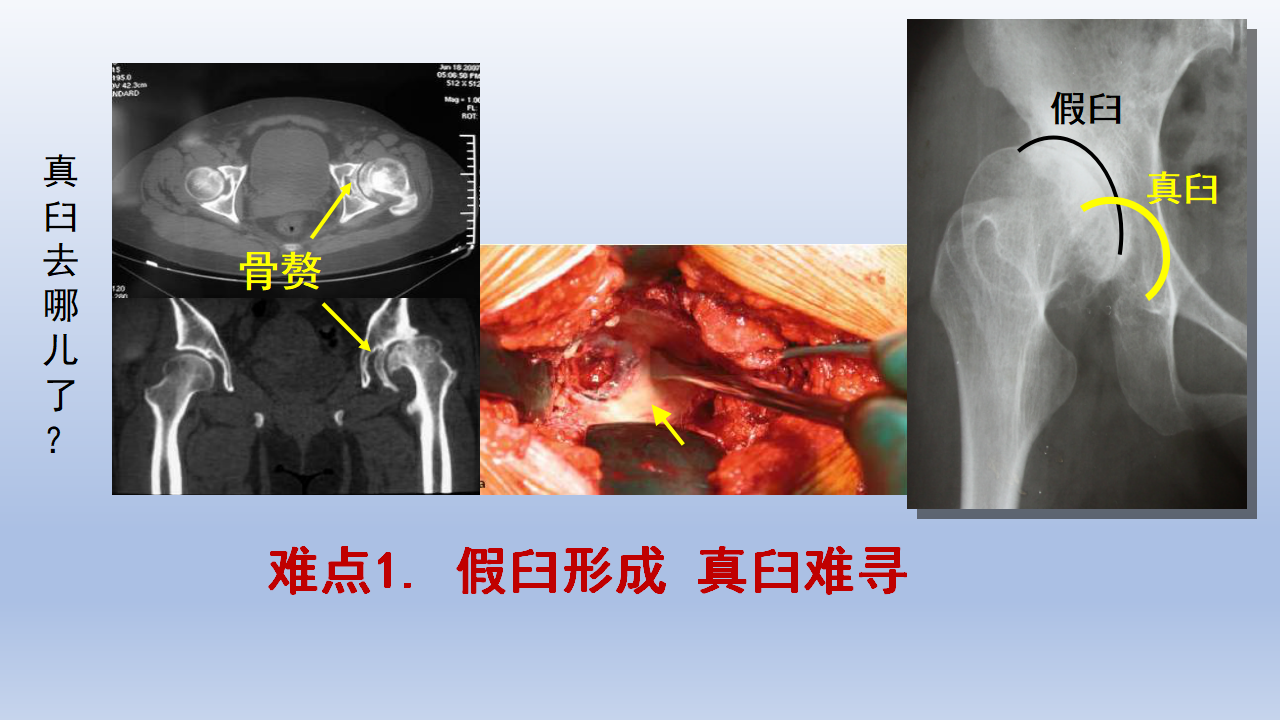 DDH全髋关节置换手术难点及对策