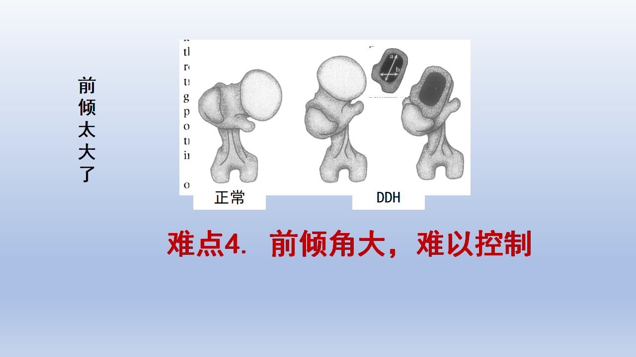 DDH全髋关节置换手术难点及对策