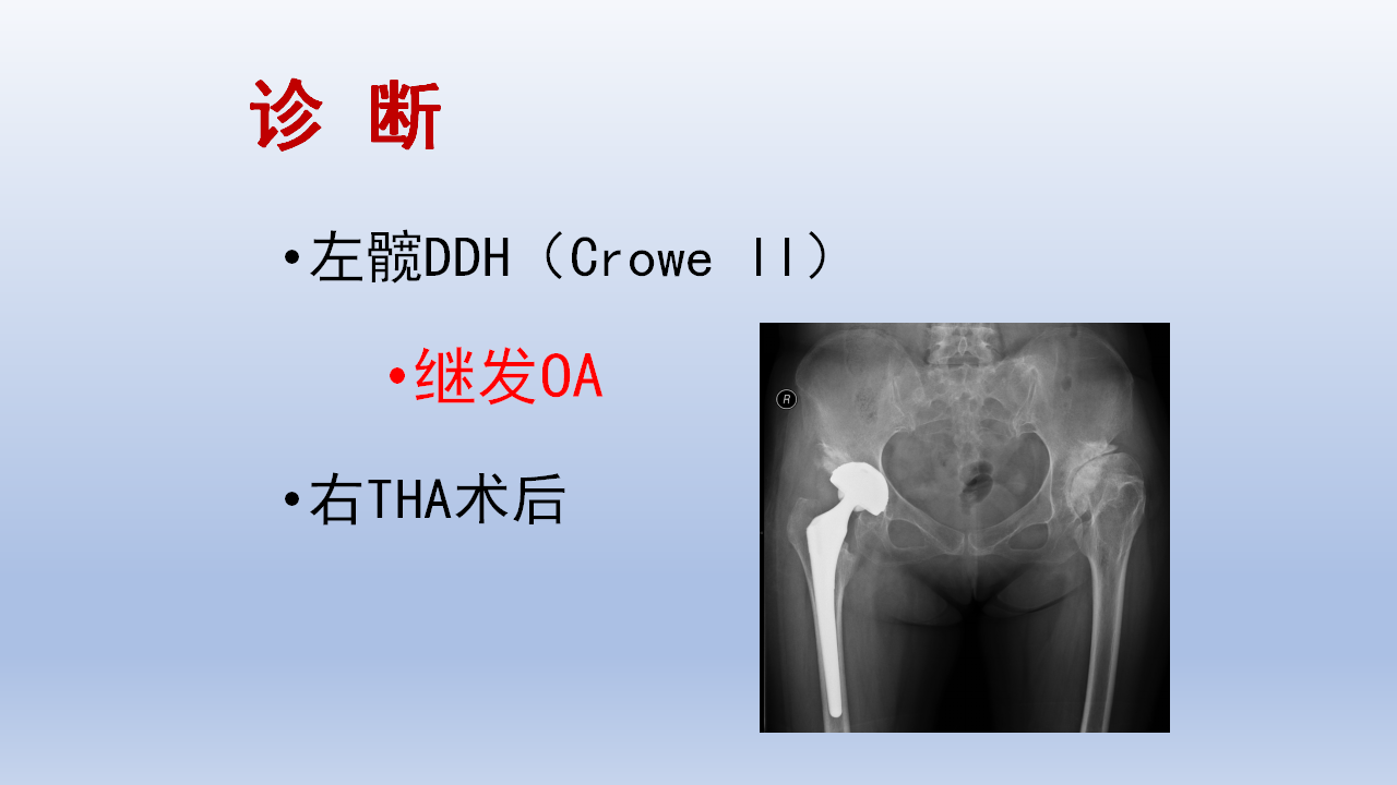 DDH全髋关节置换手术难点及对策