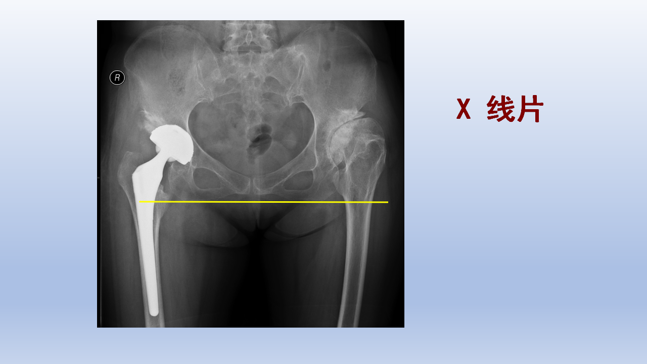 DDH全髋关节置换手术难点及对策