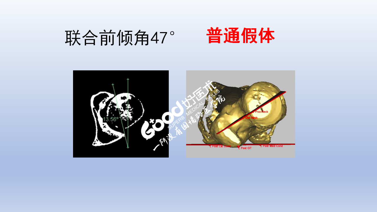 DDH全髋关节置换手术难点及对策