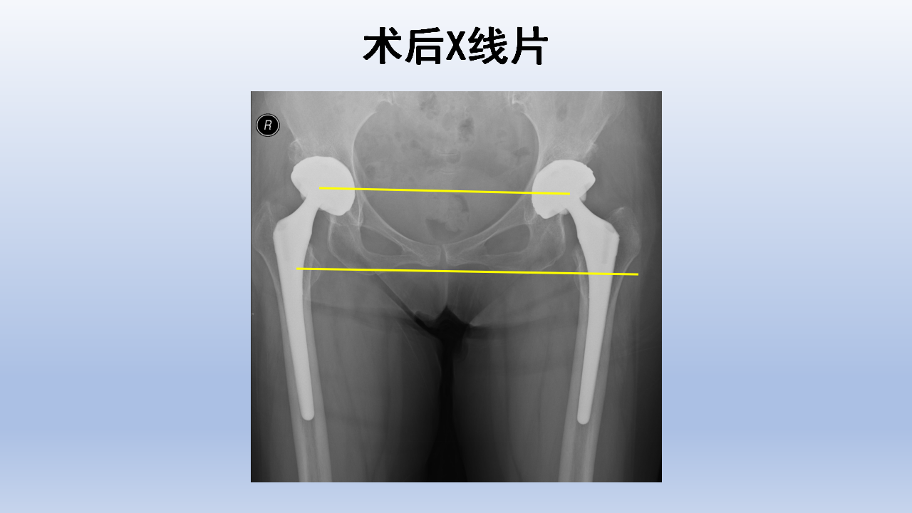 DDH全髋关节置换手术难点及对策