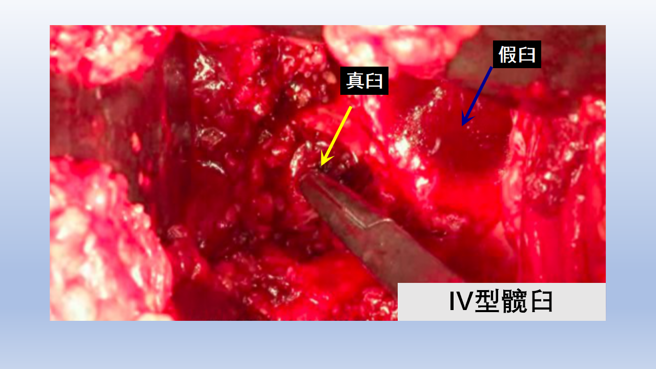 DDH全髋关节置换手术难点及对策