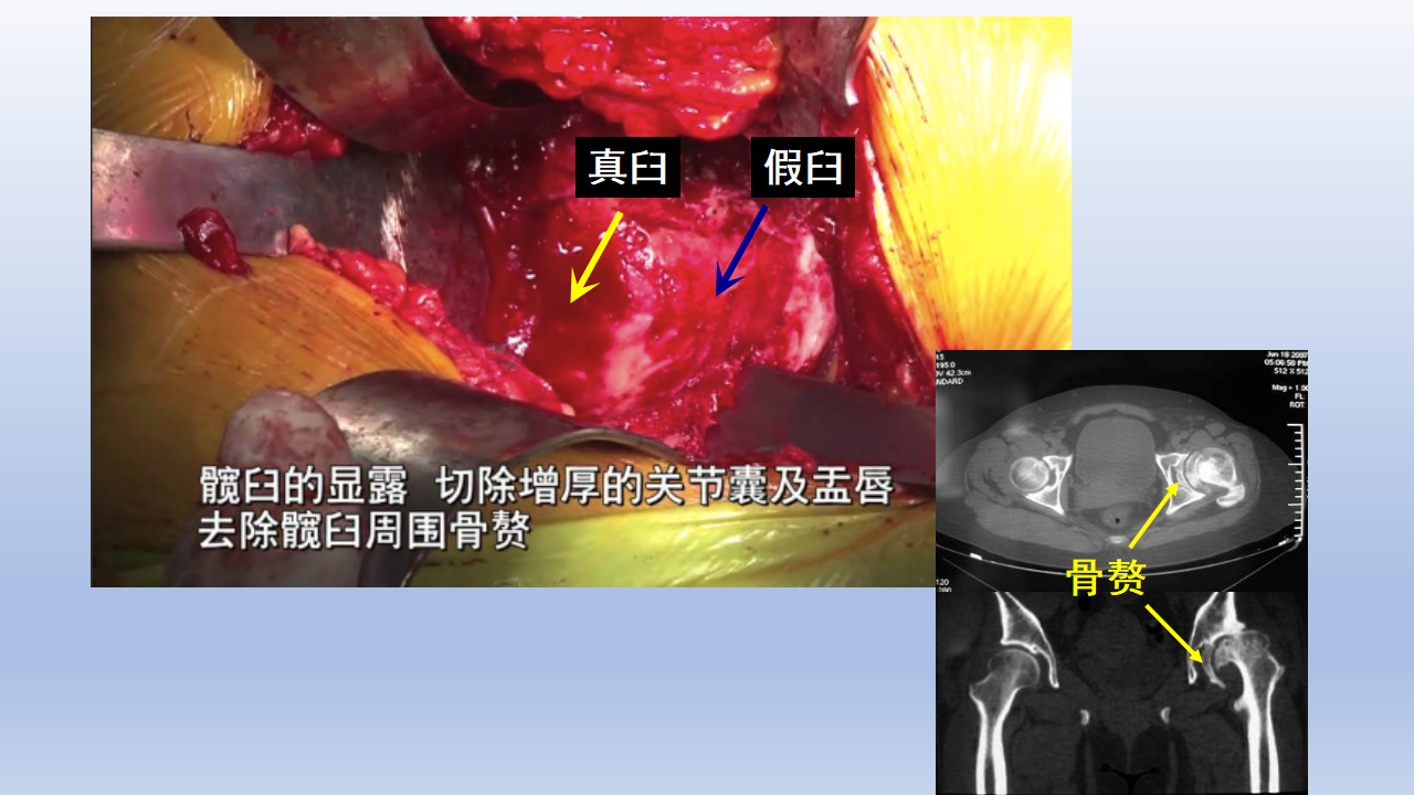 DDH全髋关节置换手术难点及对策