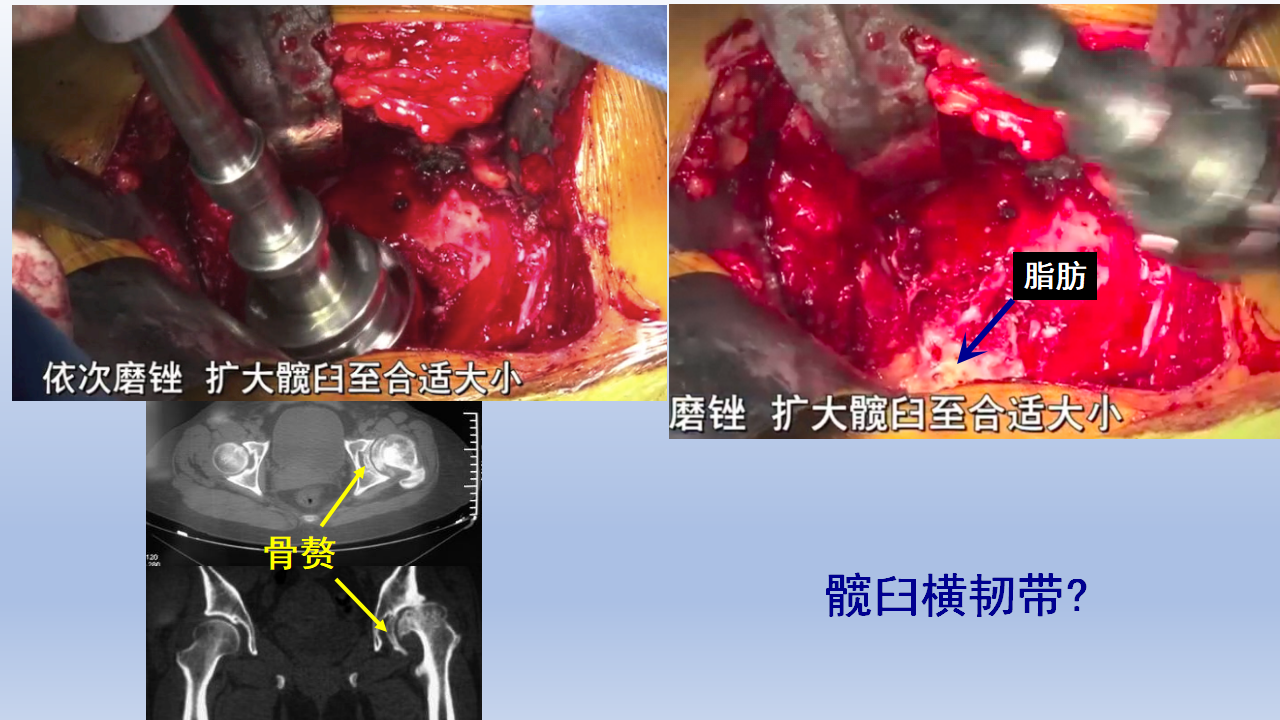 DDH全髋关节置换手术难点及对策