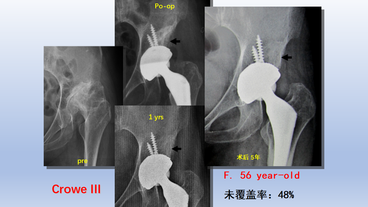 DDH全髋关节置换手术难点及对策