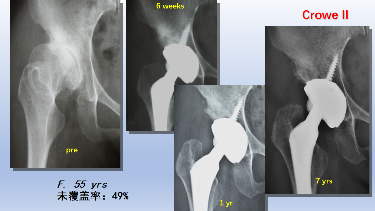 DDH全髋关节置换手术难点及对策