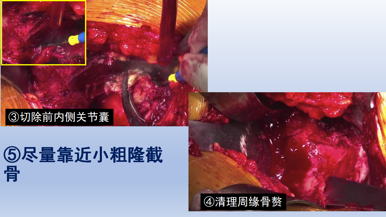 DDH全髋关节置换手术难点及对策