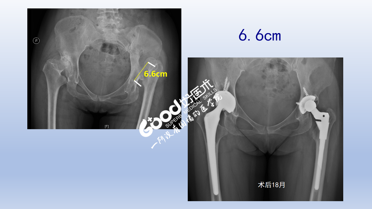 DDH全髋关节置换手术难点及对策