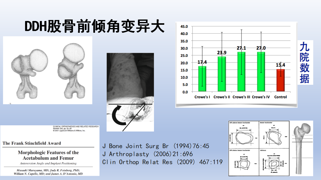 DDH全髋关节置换手术难点及对策