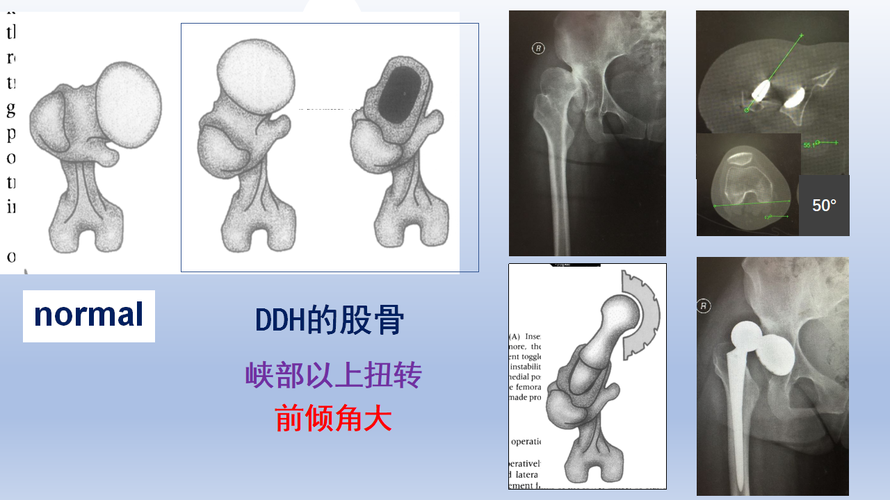 DDH全髋关节置换手术难点及对策