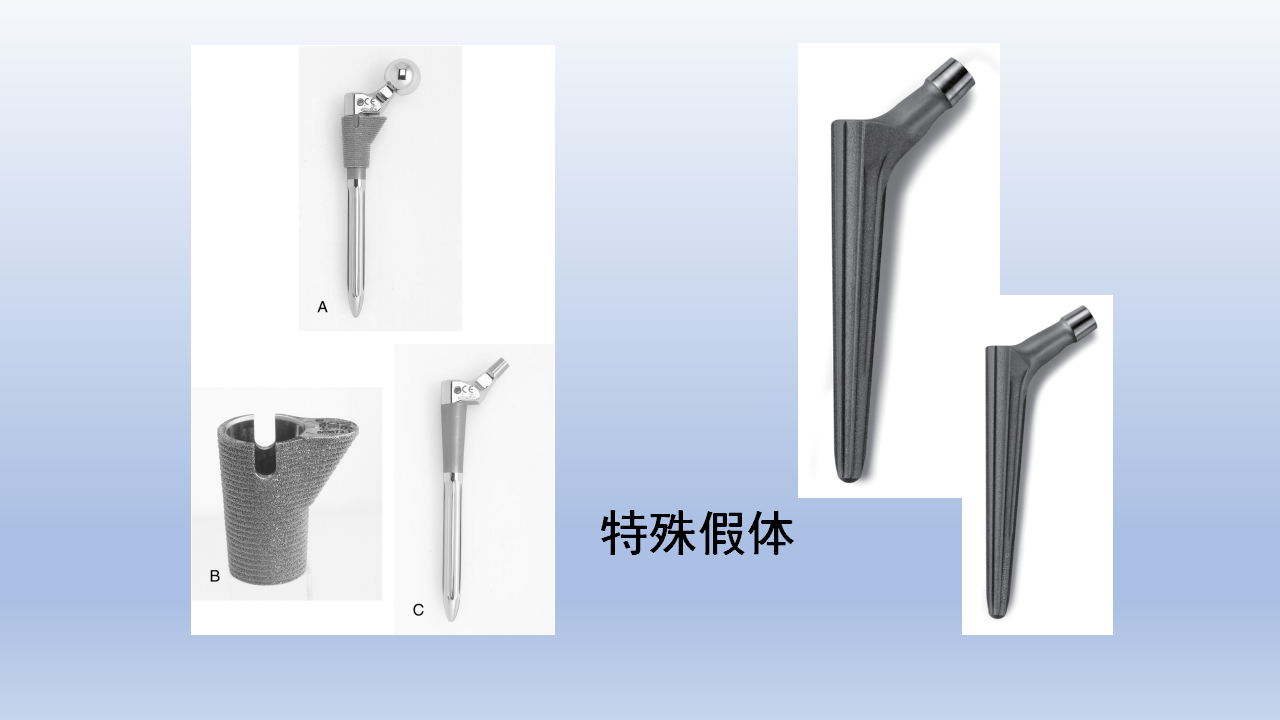 DDH全髋关节置换手术难点及对策