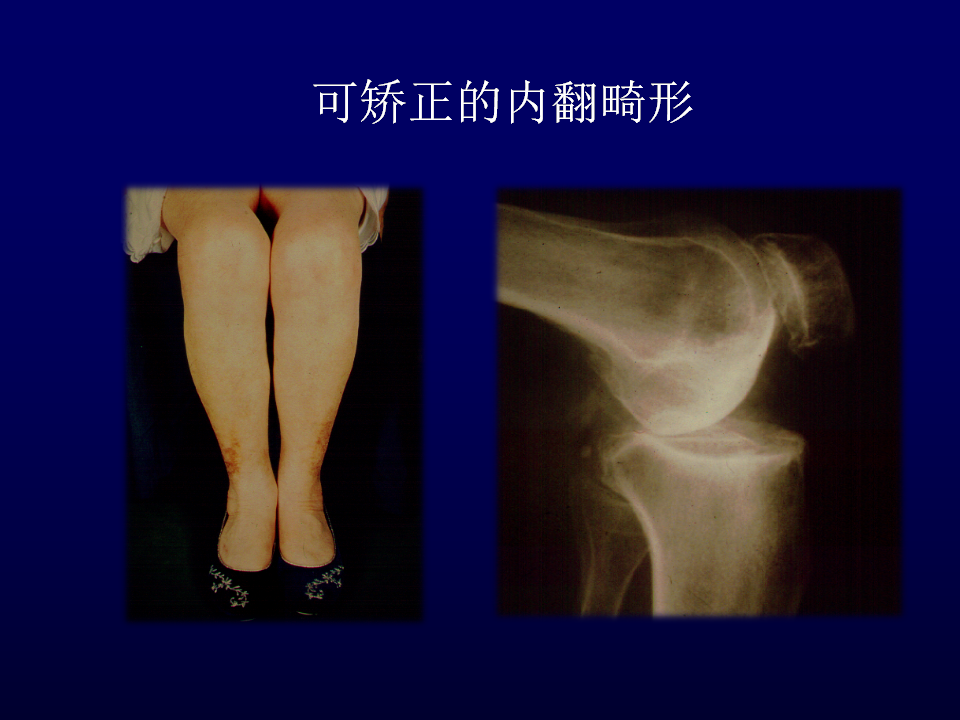 单髁置换术治疗膝关节骨性关节炎